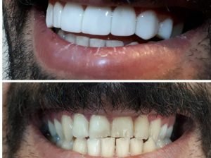 ارائه باکیفیت‌ترین کامپوزیت‌های دندان در ترکیه