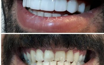 ارائه باکیفیت‌ترین کامپوزیت‌های دندان در ترکیه